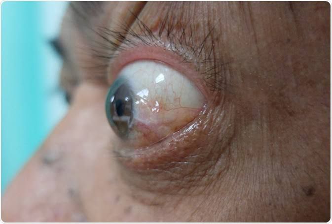 eye clinic mira bhayandar